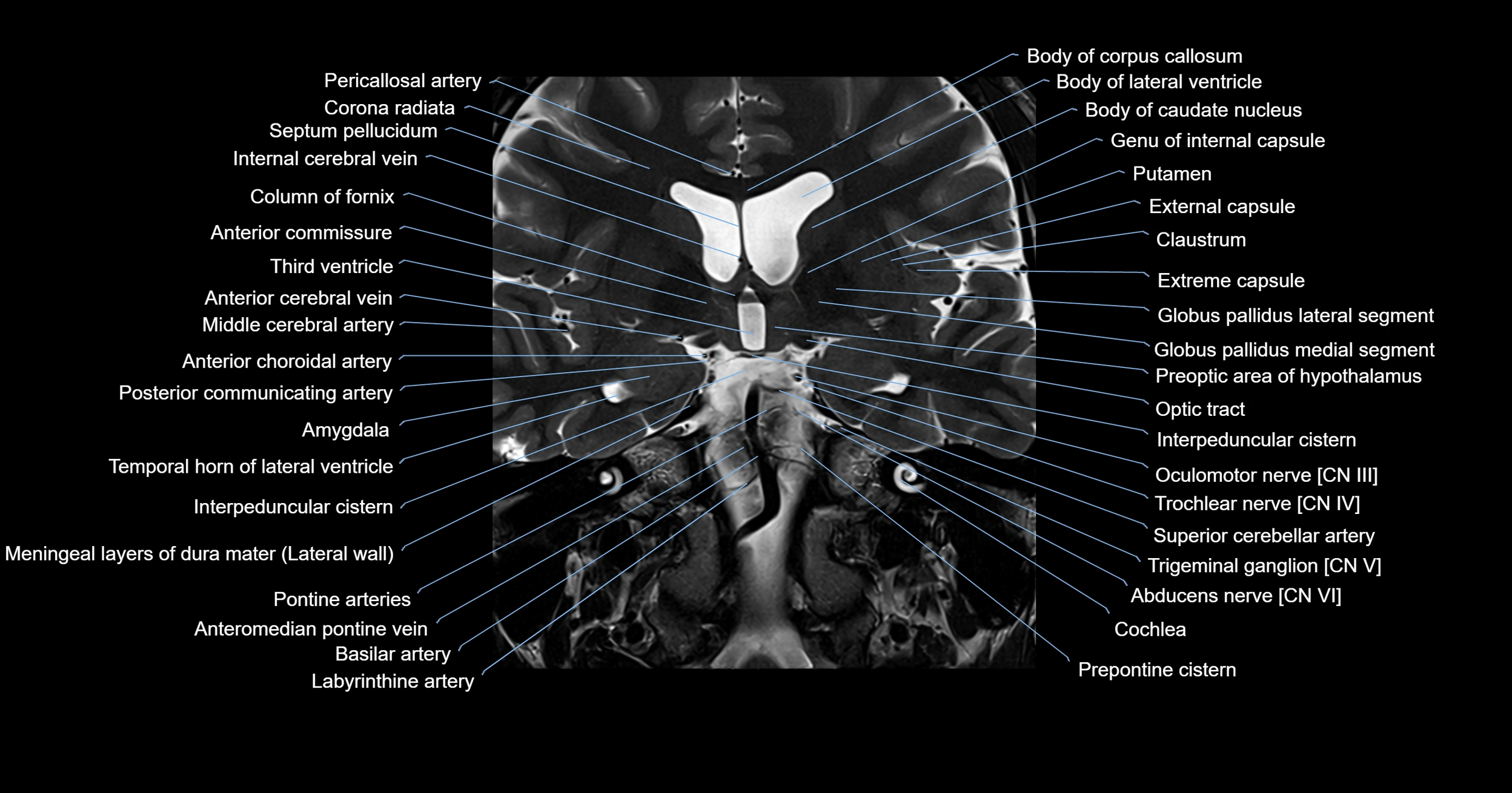 MRI brainstem & basal ganglia anatomy labelled 3T MRI images -img-00001-00016.webp